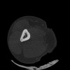 SPORK, NICO - 22.03.1976 - 02.08.2022 - CT obere Extremität - 17:51:17